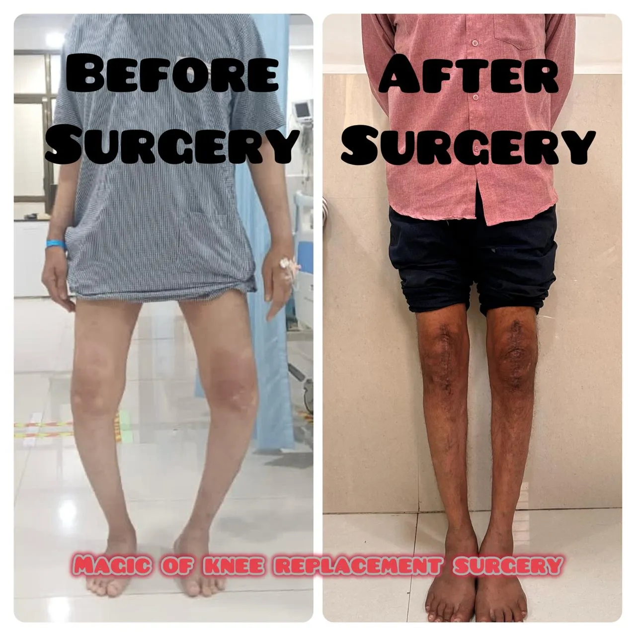 Before and after bilateral knee replacement surgery, showing leg alignment before surgery and after surgery